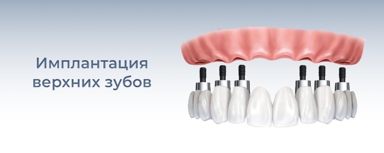 имплантация жевательных зубов